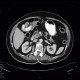Lipoma of pancreas: CT - Computed tomography